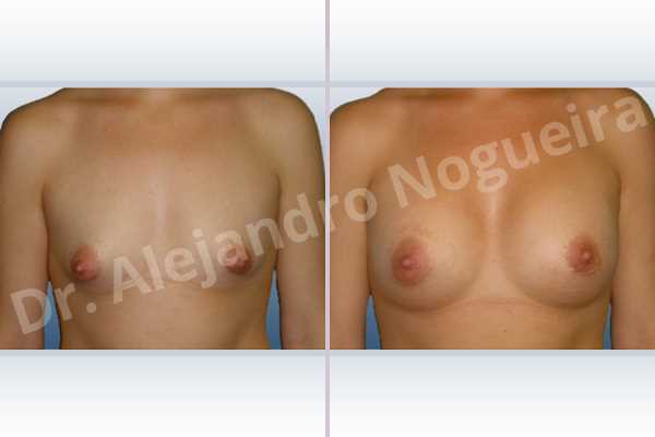 Asymmetric breasts,Cross eyed breasts,Narrow breasts,Small breasts,Tuberous breasts,Lower hemi periareolar incision,Round shape,Subfascial pocket plane,Tuberous mammoplasty - photo 1