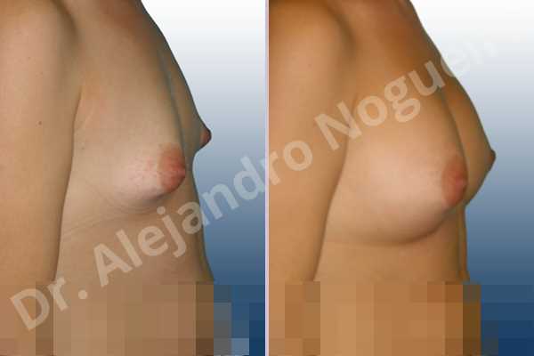 Asymmetric breasts,Cross eyed breasts,Narrow breasts,Small breasts,Tuberous breasts,Lower hemi periareolar incision,Round shape,Subfascial pocket plane,Tuberous mammoplasty - photo 4