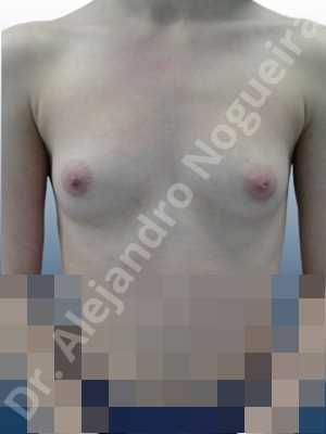 Cross eyed breasts,Empty breasts,Narrow breasts,Skinny breasts,Small breasts,Lower hemi periareolar incision,Round shape,Subfascial pocket plane