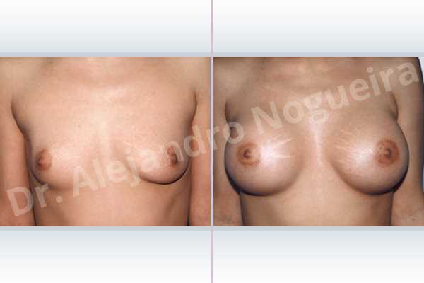 Asymmetric breasts,Cross eyed breasts,Empty breasts,Lateral breasts,Skinny breasts,Slightly saggy droopy breasts,Small breasts,Too far apart wide cleavage breasts,Lower hemi periareolar incision,Round shape,Subfascial pocket plane - photo 1