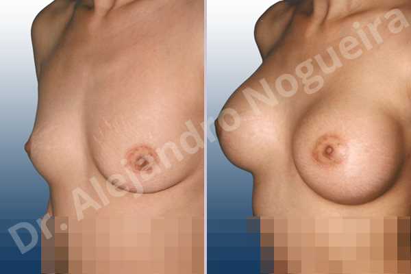 Asymmetric breasts,Cross eyed breasts,Empty breasts,Lateral breasts,Skinny breasts,Slightly saggy droopy breasts,Small breasts,Too far apart wide cleavage breasts,Lower hemi periareolar incision,Round shape,Subfascial pocket plane - photo 2
