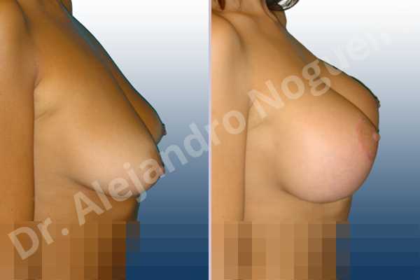 Asymmetric breasts,Empty breasts,Mildly saggy droopy breasts,Moderately saggy droopy breasts,Small breasts,Tuberous breasts,Extra large size,Lollipop incision,Round shape,Subfascial pocket plane,Superior pedicle - photo 4