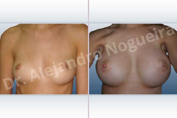 Asymmetric breasts,Cross eyed breasts,Lateral breasts,Skinny breasts,Too far apart wide cleavage breasts,Anatomical shape,Extra large size,Lower hemi periareolar incision,Subfascial pocket plane - photo 1