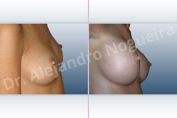 Asymmetric breasts,Cross eyed breasts,Lateral breasts,Skinny breasts,Too far apart wide cleavage breasts,Anatomical shape,Extra large size,Lower hemi periareolar incision,Subfascial pocket plane - photo 4