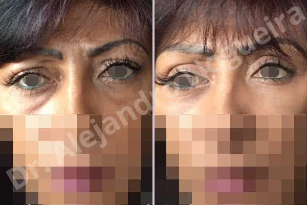 Baggy lower eyelids,Baggy upper eyelids,Saggy upper eyelids,Upper eyelids ptosis,Lower eyelid fat bags resection,Transconjunctival approach incision,Upper eyelid fat bags resection,Upper eyelid skin and muscle resection - photo 1