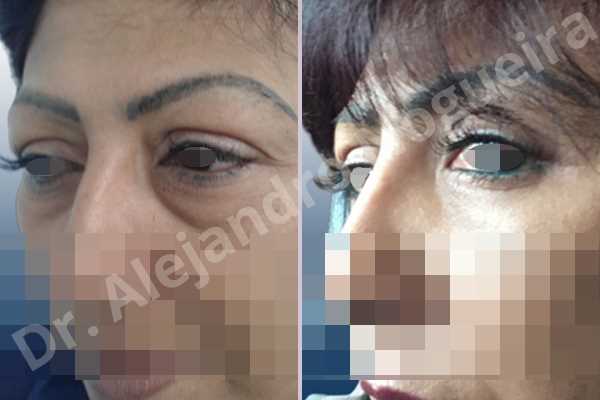 Baggy lower eyelids,Baggy upper eyelids,Saggy upper eyelids,Upper eyelids ptosis,Lower eyelid fat bags resection,Transconjunctival approach incision,Upper eyelid fat bags resection,Upper eyelid skin and muscle resection - photo 5