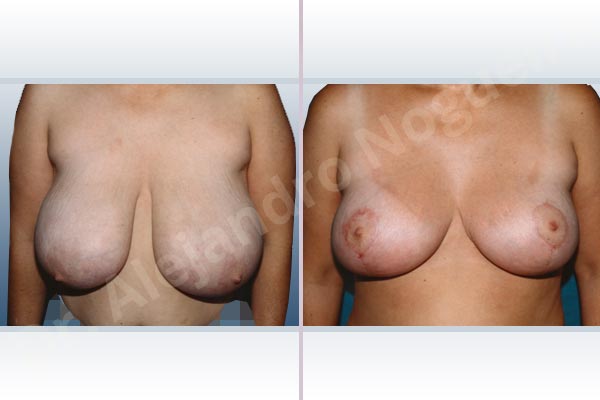 Asymmetric breasts,Breast tissue bottoming out,Cross eyed breasts,Extremely large breasts,Extremely saggy droopy breasts,Pendulous breasts,Severely large breasts,Severely saggy droopy breasts,Tuberous breasts,Anchor incision,Double vertical pedicle - photo 1
