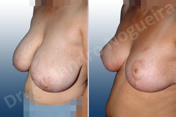 Asymmetric breasts,Breast tissue bottoming out,Cross eyed breasts,Extremely large breasts,Extremely saggy droopy breasts,Pendulous breasts,Severely large breasts,Severely saggy droopy breasts,Tuberous breasts,Anchor incision,Double vertical pedicle - photo 2