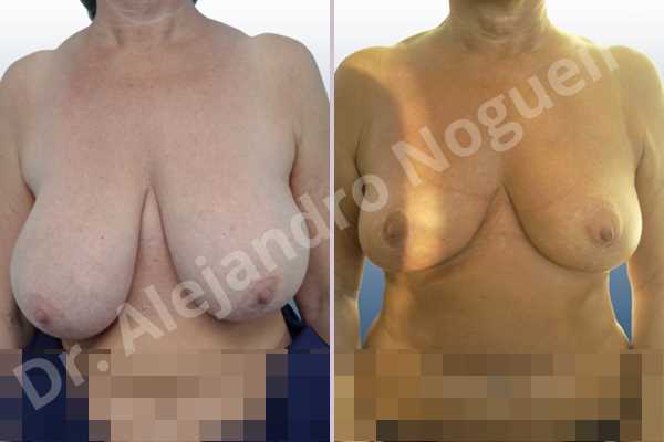 Asymmetric breasts,Breast tissue bottoming out,Cross eyed breasts,Extremely saggy droopy breasts,Mildly large breasts,Pendulous breasts,Severely large breasts,Tuberous breasts,Anchor incision,Double vertical pedicle - photo 1
