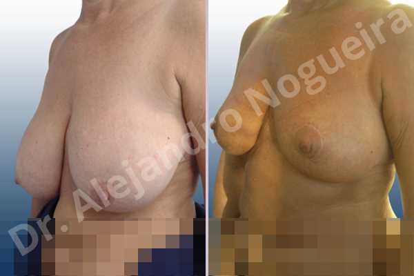 Asymmetric breasts,Breast tissue bottoming out,Cross eyed breasts,Extremely saggy droopy breasts,Mildly large breasts,Pendulous breasts,Severely large breasts,Tuberous breasts,Anchor incision,Double vertical pedicle - photo 3