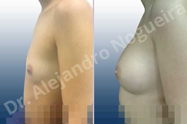 Asymmetric breasts,Lateral breasts,Narrow breasts,Skinny breasts,Small breasts,Too far apart wide cleavage breast implants,Anatomical shape,Inframammary incision,Subfascial pocket plane - photo 2
