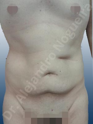 Saggy abdomen,Standard abdominoplasty