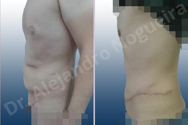 Saggy abdomen,Standard abdominoplasty - photo 2