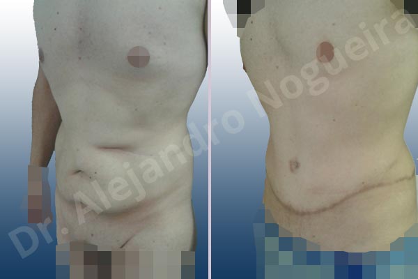 Saggy abdomen,Standard abdominoplasty - photo 3