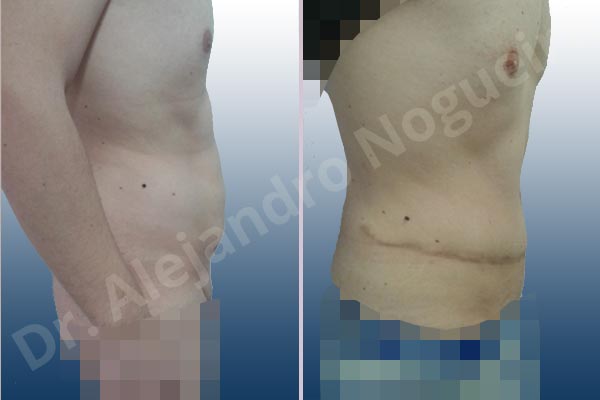 Saggy abdomen,Standard abdominoplasty - photo 4