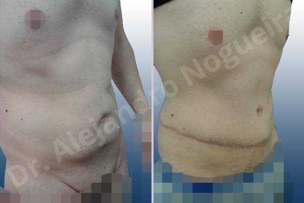 Saggy abdomen,Standard abdominoplasty - photo 5