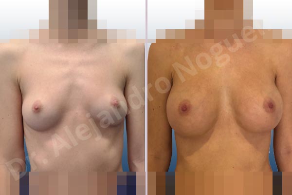 Asymmetric breasts,Empty breasts,Lateral breasts,Narrow breasts,Skinny breasts,Small breasts,Sunken chest,Too far apart wide cleavage breasts,Anatomical shape,Extra large size,Inframammary incision,Subfascial pocket plane - photo 1