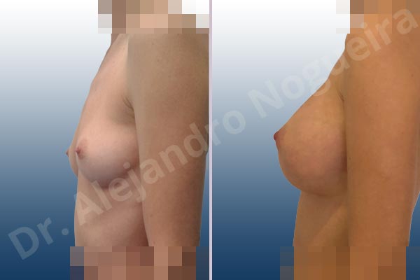 Asymmetric breasts,Empty breasts,Lateral breasts,Narrow breasts,Skinny breasts,Small breasts,Sunken chest,Too far apart wide cleavage breasts,Anatomical shape,Extra large size,Inframammary incision,Subfascial pocket plane - photo 2