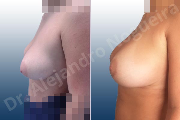 Asymmetric breasts,Empty breasts,Mildly large breasts,Moderately saggy droopy breasts,Wide breasts,Anatomical shape,Extra large size,Lower hemi periareolar incision,Subfascial pocket plane - photo 2