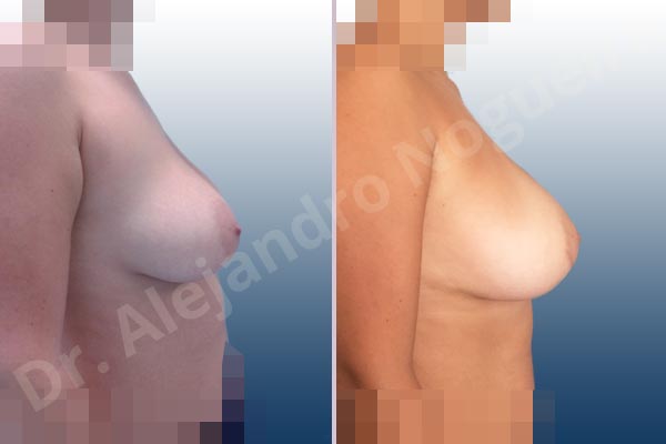 Asymmetric breasts,Empty breasts,Mildly large breasts,Moderately saggy droopy breasts,Wide breasts,Anatomical shape,Extra large size,Lower hemi periareolar incision,Subfascial pocket plane - photo 4