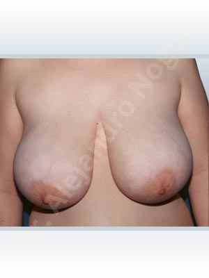 Asymmetric breasts,Extremely saggy droopy breasts,Large areolas,Pendulous breasts,Severely large breasts,Tuberous breasts,Anchor incision,Areola reduction,Double vertical pedicle