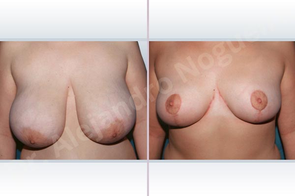 Asymmetric breasts,Extremely saggy droopy breasts,Large areolas,Pendulous breasts,Severely large breasts,Tuberous breasts,Anchor incision,Areola reduction,Double vertical pedicle - photo 1