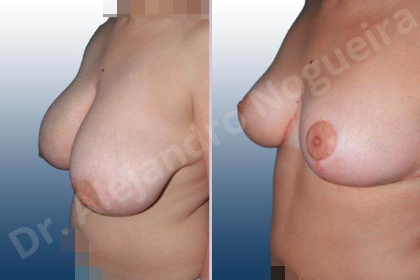 Asymmetric breasts,Extremely saggy droopy breasts,Large areolas,Pendulous breasts,Severely large breasts,Tuberous breasts,Anchor incision,Areola reduction,Double vertical pedicle - photo 2