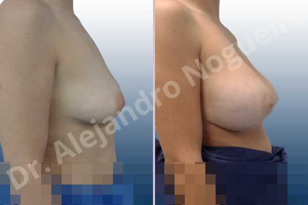 Empty breasts,Moderately saggy droopy breasts,Slightly large breasts,Wide breasts,Anatomical shape,Extra large size,Lower hemi periareolar incision,Subfascial pocket plane - photo 4