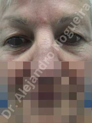 Baggy lower eyelids,Saggy upper eyelids,Lower eyelid fat bags resection,Transconjunctival approach incision,Upper eyelid skin and muscle resection