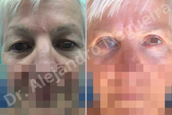 Baggy lower eyelids,Saggy upper eyelids,Lower eyelid fat bags resection,Transconjunctival approach incision,Upper eyelid skin and muscle resection - photo 1