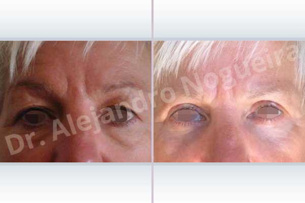 Baggy lower eyelids,Saggy upper eyelids,Lower eyelid fat bags resection,Transconjunctival approach incision,Upper eyelid skin and muscle resection - photo 2