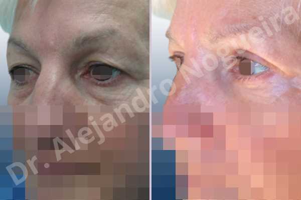 Baggy lower eyelids,Saggy upper eyelids,Lower eyelid fat bags resection,Transconjunctival approach incision,Upper eyelid skin and muscle resection - photo 4