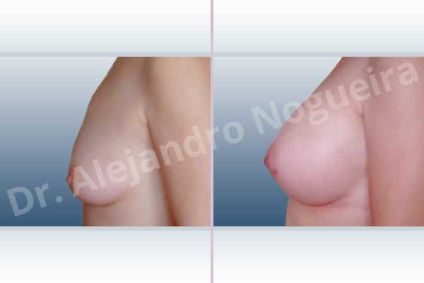 Asymmetric breasts,Empty breasts,Mildly saggy droopy breasts,Small breasts,Anatomical shape,Lower hemi periareolar incision,Subfascial pocket plane,Extra large size - photo 2