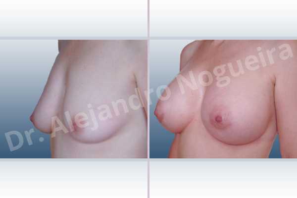 Asymmetric breasts,Empty breasts,Mildly saggy droopy breasts,Small breasts,Anatomical shape,Lower hemi periareolar incision,Subfascial pocket plane,Extra large size - photo 3