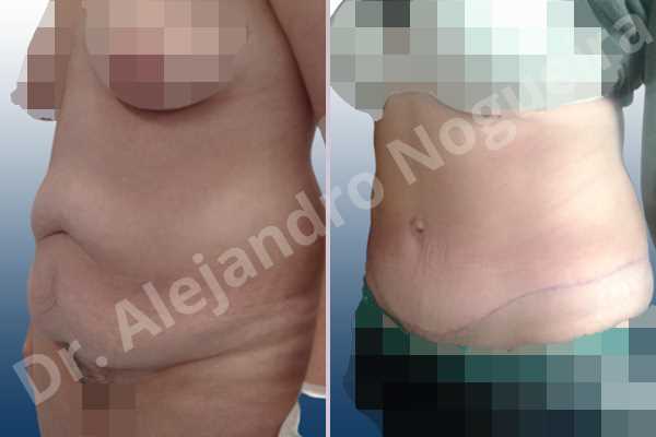 Saggy abdomen,Weak abdomen muscles,Standard abdominoplasty - photo 3
