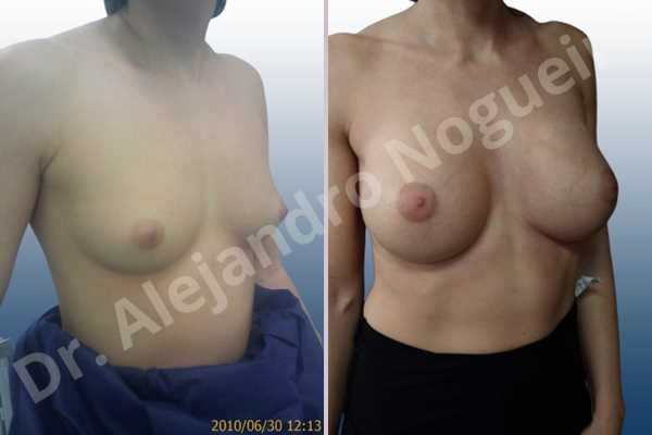 Empty breasts,Lateral breasts,Skinny breasts,Small breasts,Too far apart wide cleavage breasts,Wide breasts,Anatomical shape,Extra large size,Inframammary incision,Subfascial pocket plane - photo 5