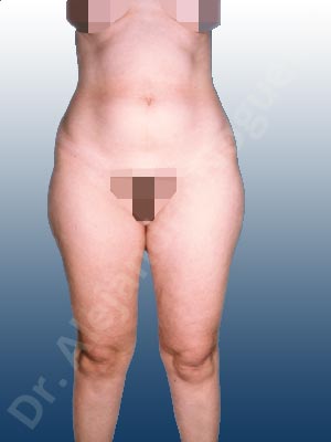 Fatty abdomen,Banana rolls flab,Fatty inner knee,Love handles flab,Saddle bags flab,Thigh gap flab,Tumescent liposuction