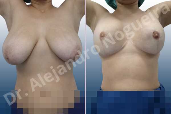 Asymmetric breasts,Empty breasts,Extremely saggy droopy breasts,Large areolas,Lateral breasts,Pendulous breasts,Severely large breasts,Too far apart wide cleavage breasts,Tuberous breasts,Anatomical shape,Anchor incision,Areola reduction,Double vertical pedicle,Extra large size,Subfascial pocket plane - photo 2