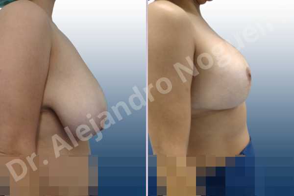 Asymmetric breasts,Empty breasts,Extremely saggy droopy breasts,Large areolas,Lateral breasts,Pendulous breasts,Severely large breasts,Too far apart wide cleavage breasts,Tuberous breasts,Anatomical shape,Anchor incision,Areola reduction,Double vertical pedicle,Extra large size,Subfascial pocket plane - photo 5