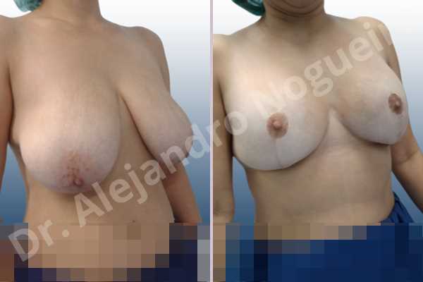Asymmetric breasts,Empty breasts,Extremely saggy droopy breasts,Large areolas,Lateral breasts,Pendulous breasts,Severely large breasts,Too far apart wide cleavage breasts,Tuberous breasts,Anatomical shape,Anchor incision,Areola reduction,Double vertical pedicle,Extra large size,Subfascial pocket plane - photo 6