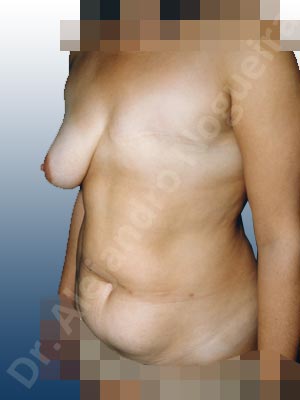 Asymmetric breasts,Breast loss mastectomy,Nipple areola complex reconstruction,Unilateral TRAM flap breast reconstruction,Free nipple areola complex graft