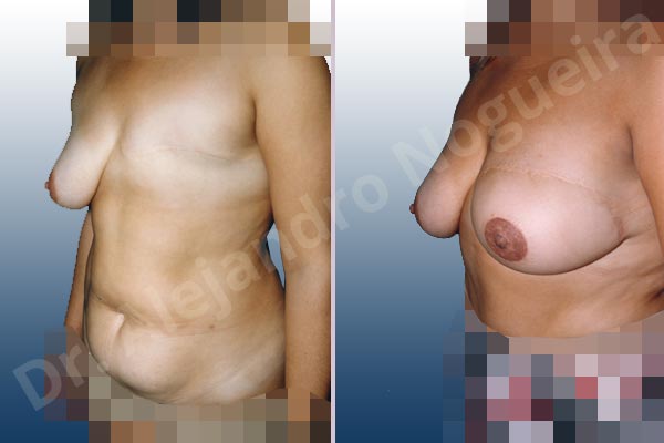 Asymmetric breasts,Breast loss mastectomy,Nipple areola complex reconstruction,Unilateral TRAM flap breast reconstruction,Free nipple areola complex graft - photo 1