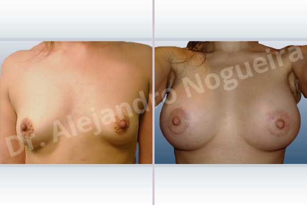 Asymmetric breasts,Lateral breasts,Small breasts,Too far apart wide cleavage breasts,Tuberous breasts,Anatomical shape,Areola reduction,Circumareolar incision,Subfascial pocket plane,Tuberous mammoplasty,Extra large size - photo 1