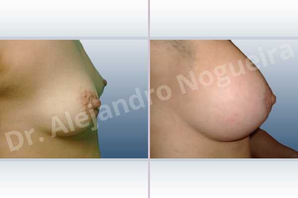 Asymmetric breasts,Lateral breasts,Small breasts,Too far apart wide cleavage breasts,Tuberous breasts,Anatomical shape,Areola reduction,Circumareolar incision,Subfascial pocket plane,Tuberous mammoplasty,Extra large size - photo 4