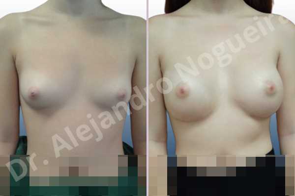 Asymmetric breasts,Empty breasts,Lateral breasts,Narrow breasts,Small breasts,Too far apart wide cleavage breasts,Anatomical shape,Inframammary incision,Subfascial pocket plane - photo 1