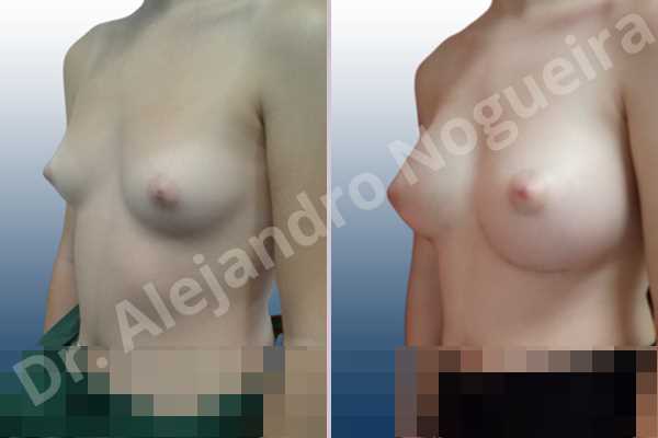 Asymmetric breasts,Empty breasts,Lateral breasts,Narrow breasts,Small breasts,Too far apart wide cleavage breasts,Anatomical shape,Inframammary incision,Subfascial pocket plane - photo 3
