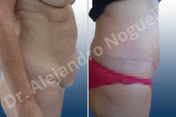 Saggy abdomen,Weak abdomen muscles,Standard abdominoplasty - photo 4