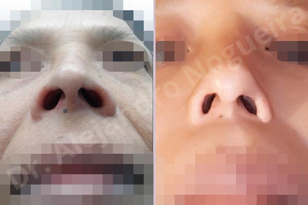 Alar flaring,Alar rim retraction,Andine nose,Angled dorsum,Asymmetric nose,Asymmetric tip,Dorsum hump,Dorsum ridges,Droopy tip,Dynamic alar flaring,Failed osteotomies,Hispanic nose,Hourglass dorsum,Inverted V deformity,Irregular dorsum,Large nostrils,Large sills,Nasal fibrosis,Nasal valve collapse,Open roof deformity,Overrotated tip,Pinched middle vault,Pinched nose,Polly beak deformity,Poorly supported tip,Short nose,Short septum,Short upper lateral cartilages,Step off deformity,Sunken columella,Thin skin nose,Tombstone dorsum deformity,Underprojected tip,Alar base resection alarplasty,Columella strut graft,Dorsum hump resection,Dorsum regularization,Ear cartilage graft harvesting,Extended columella strut graft,Intercrural columella plasty sutures,Interdomal tip plasty sutures,Lateral cruras batten graft,Lateral cruras caudal extension graft,Nasal bones osteotomies,Nostril sill resection,Open approach incision,Septal cartilage graft harvesting,Septocolumella graft,Septum caudal extension graft,Septum replacement graft,Spreader graft,Temporalis fascia graft harvesting,Tongue in groove columella setback,Transdomal tip plasty sutures - photo 2
