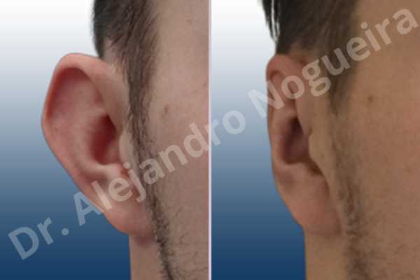 Prominent ears,Mustardé antihelical suturing - photo 5