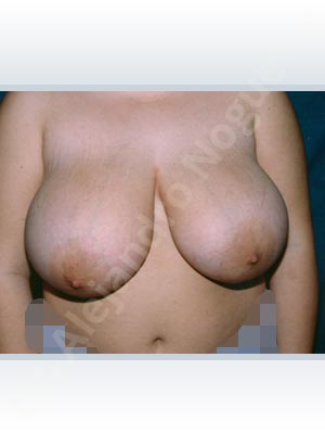 Asymmetric breasts,Breast tissues symmastia uniboob,Extremely saggy droopy breasts,Large areolas,Lateral breasts,Pendulous breasts,Severely large breasts,Tuberous breasts,Anchor incision,Areola reduction,Double vertical pedicle